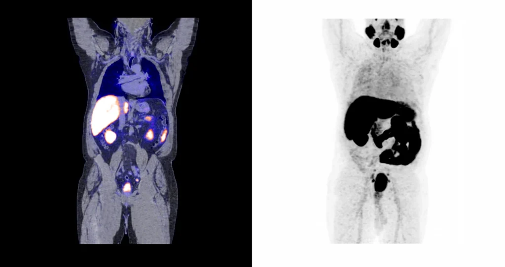 Опухолевые образования предстательной железы aboutImage Опухолевые образования предстательной железы с метастазами в тазовые лимфатические узлы