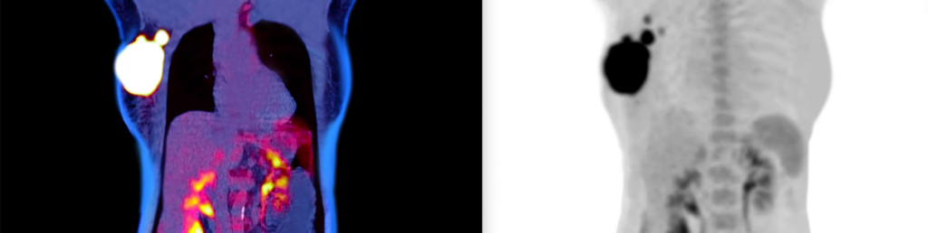 Рак молочной железы на ПЭТ/КТ снимке