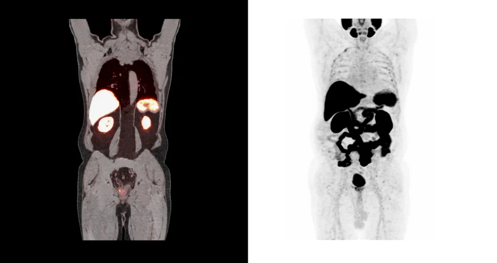 Опухолевые образования предстательной железы